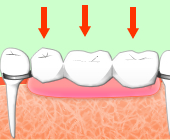 入れ歯との比較2